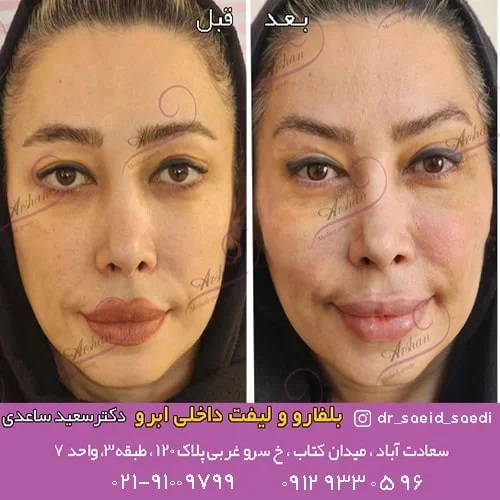 مراقبت های قبل و بعد از عمل بلفاروپلاستی