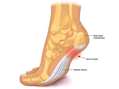 علت درد کف پا و پاشنه چیست و چگونه تشخیص داده می شود؟