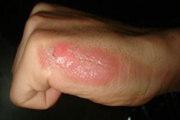 نیترات نقره (Silver Nitrate) در درمان سوختگی صنعتی و نظامی