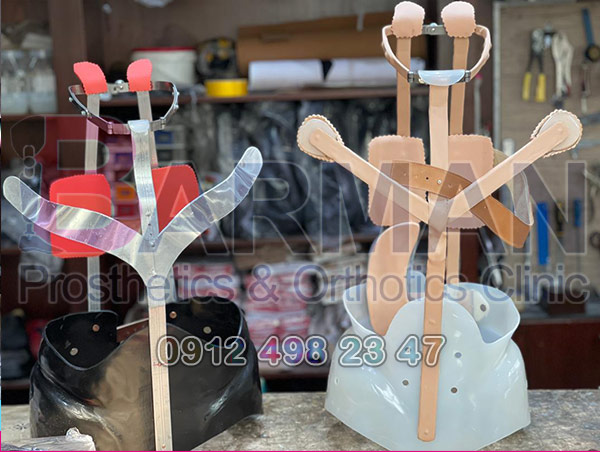 موفقیت در درمان اسکولیوز با بریس